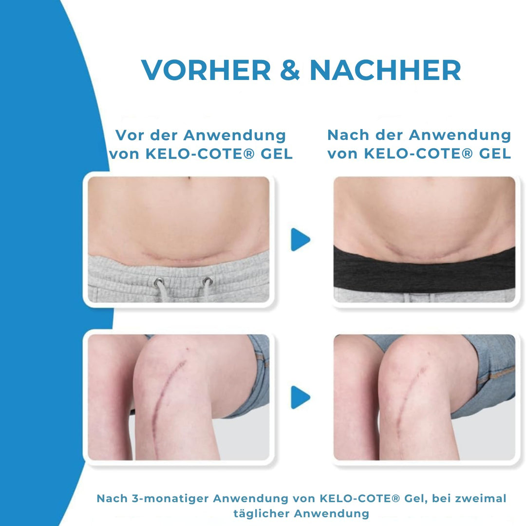 Silikongel Narbenbehandlung 60 g für hypertrophe Narben und Keloide - Bild 7