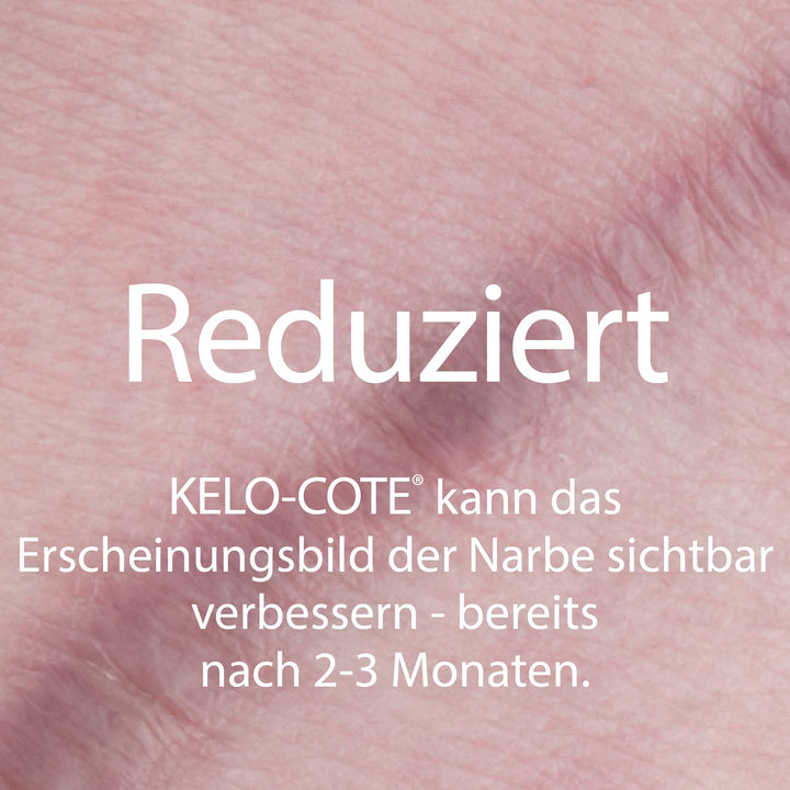 Silikongel Narbenbehandlung 60 g für hypertrophe Narben und Keloide - Bild 3
